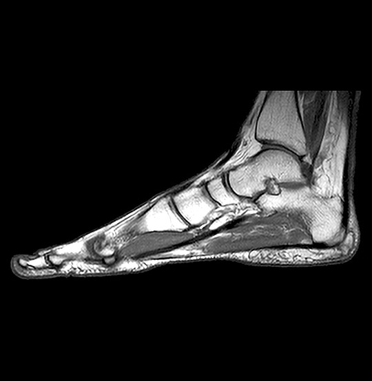 MRI Foot Scan (AI Enhanced)